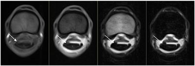 Deep Digital Flexor Tendon Injury at the Level of the Proximal Phalanx in Frontlimbs With Tendon Sheath Distension Characterized by Standing Low-Field Magnetic Resonance Imaging in Horses: 13 Cases (2015–2021)